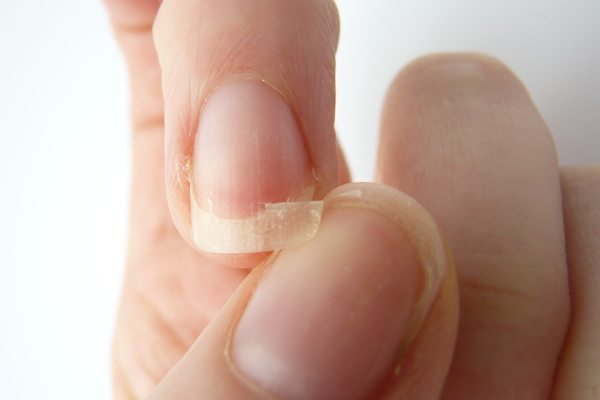Ломкость ногтей, как один из признаков нарушения кальциевого баланса при беременности