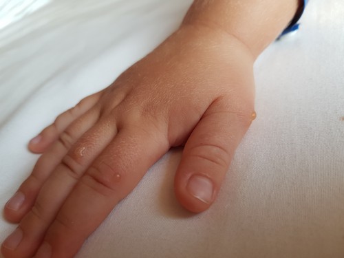 Рука ребенка с дизгидрозом