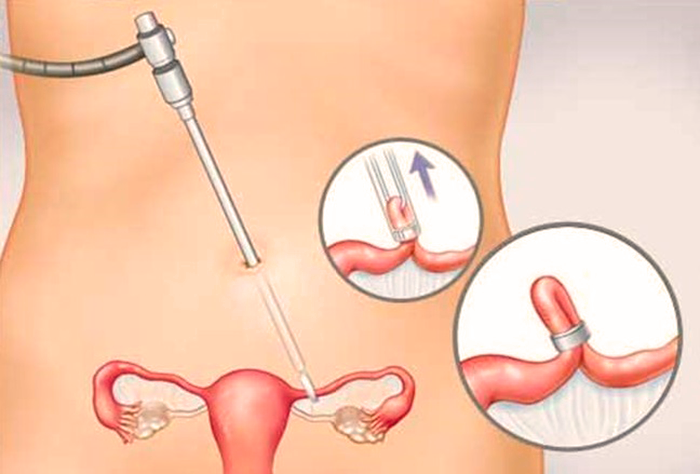Проведения лапороскопической операции при непроходимости маточных труб