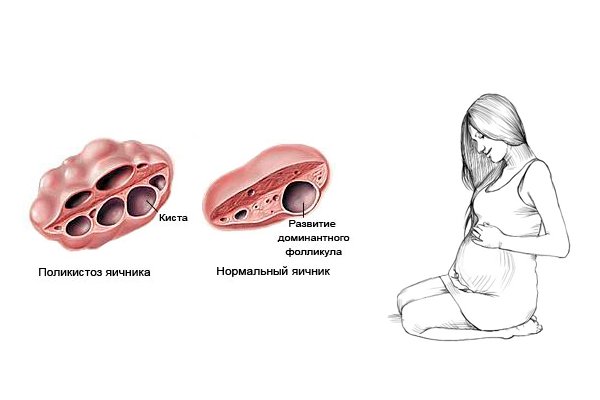 Беременность при поликистозе яичников