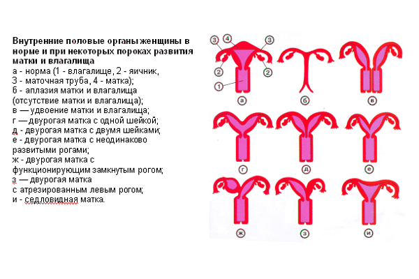 Врожденное женское бесплодие в виде аномалий строения матки