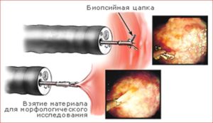 гастроскопия с биопсией