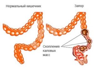 Скопление каловых масс