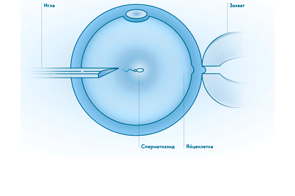 Метод ИКСИ для осуществления зачатия при процедуре ЭКО в случае астенотератозооспермии