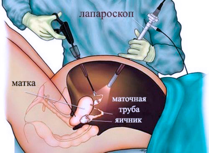 Проведения лапороскопической операции при Кисты Яичников