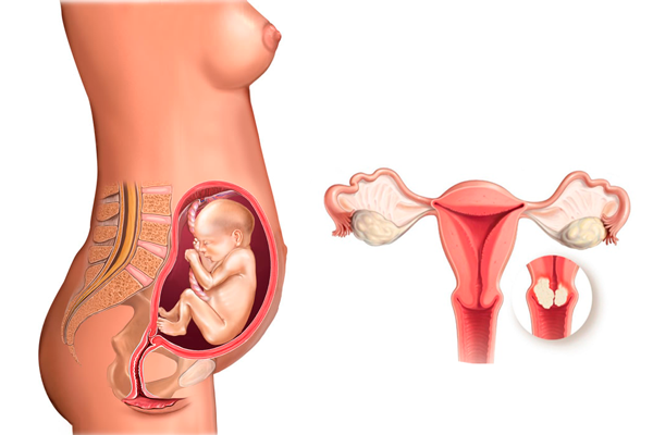 Беременность при гиперкератозе