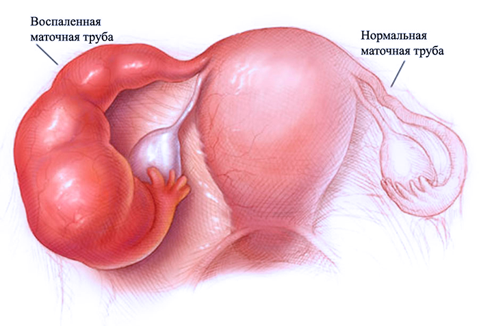 Воспалительные процессы в маточных трубах
