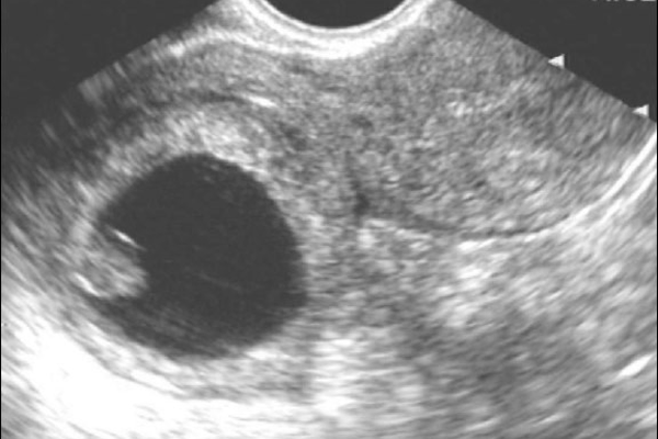 Диагностирование внематочной беременности на УЗИ