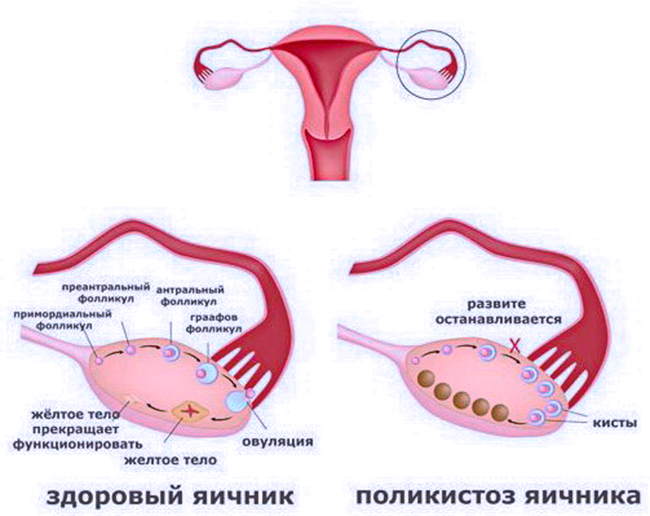Развитие Эмбриона при нормальном состояние и при поликистозе яичиников