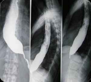Пищевод на рентгеновском снимке