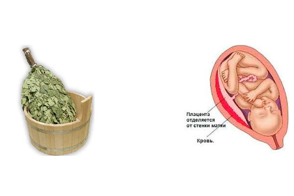 Возможная отслойка плаценты в следствии похода беременной в баню