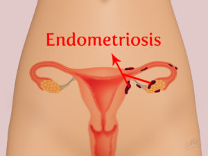 Эндометриоз