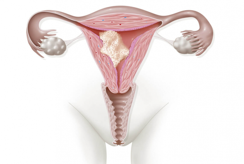 серозометра матки в менопаузе