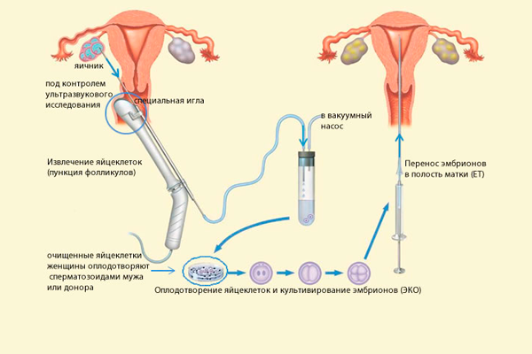 Схема проведения процедуры ЭКО