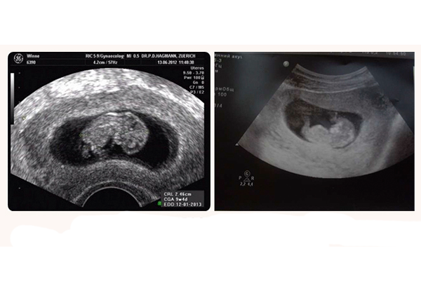 УЗИ зародыша на 11-й недели беременности