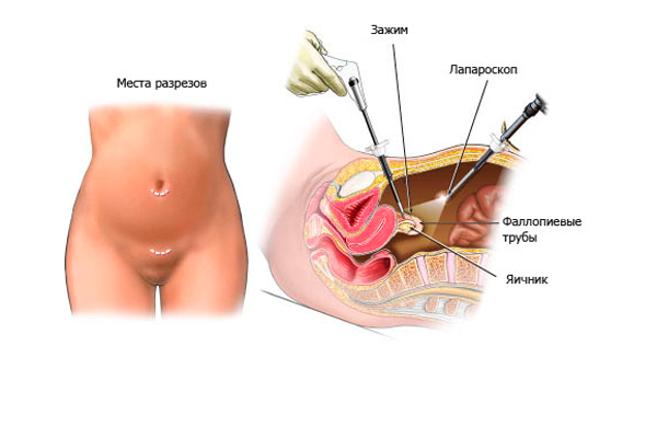 Лапароскопическая операция по удалению спаек на яичниках