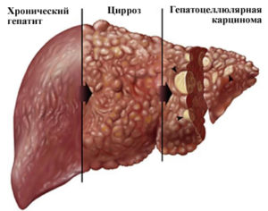 гепатит с и цирроз печени сколько живут