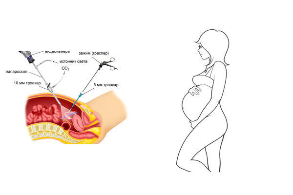 Возможная беременность после лечения каутеризацией