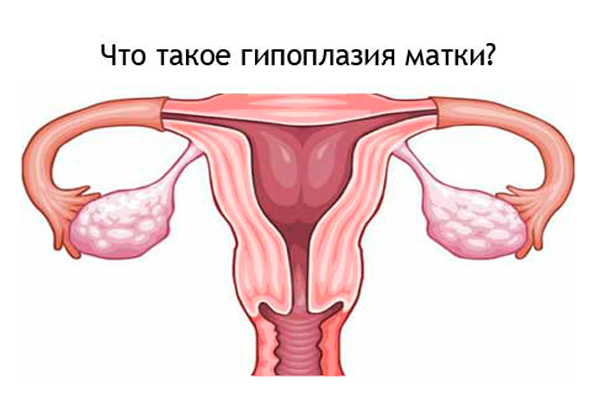 Гипоплазия матки - один из диагнозов, по которому естественной беременности быть не может