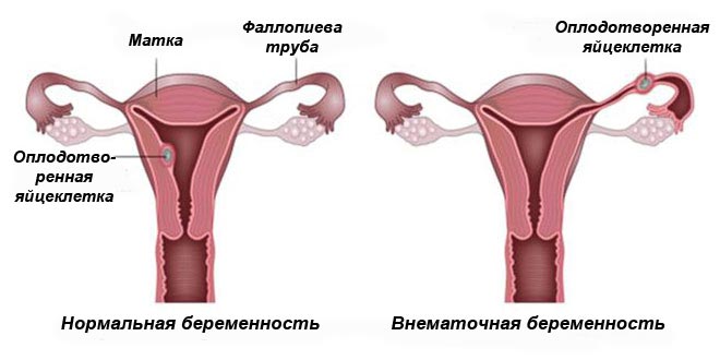 нормальная и внематочная беременности