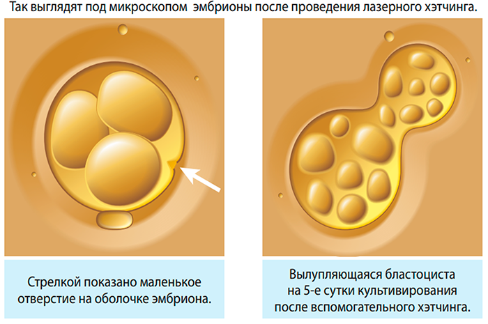 Вид эмбриона после проведения Хетчинга 
