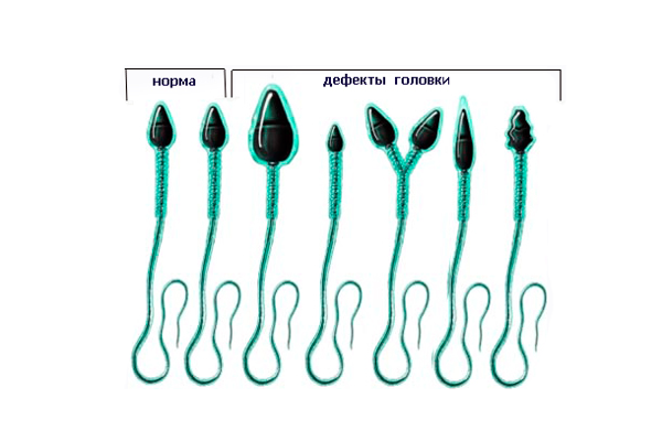 Дефекты головки спермия