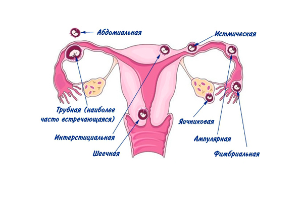 Появление спаек в следствии внематочной беременности