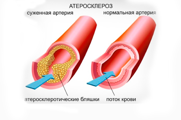 Атеросклероз, как одна из причин тромбофилии при беременности