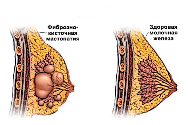 Мастопатия, как одна из болезней которую можно выявить при сдаче анализа на пролактин
