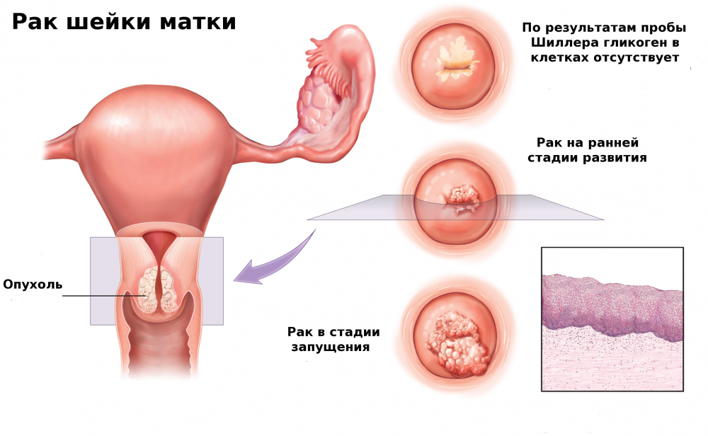 Инвазивный рак шейки матки: что это такое и основные симптомы недуга