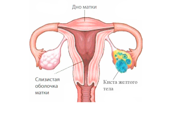 Киста желтого тела, как одна из причин повышения прогестерона