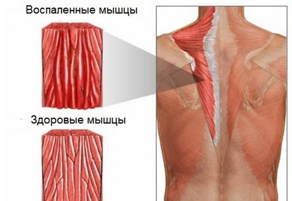 Ноющая боль под левой и правой лопаткой сзади со спины: 20 причин, почему болит и что делать?