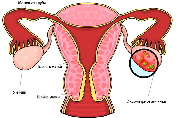 Эндометриоз яичников - одна из причин, по которой применяется заморозка яйцеклетки