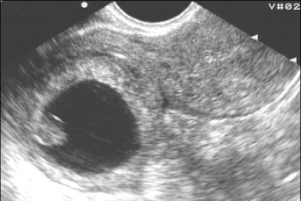 Изображение внематочной беременности на УЗИ