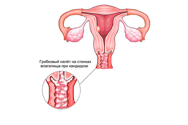 Возможный вагинальный кандидоз в следствии применения противозачаточных средств 