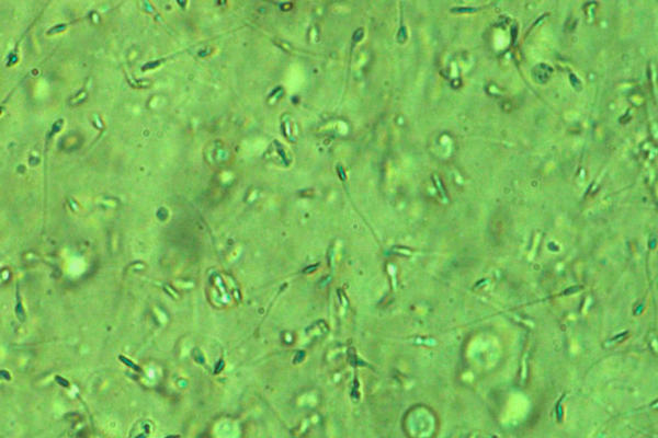 Астенотератозооспермия под микроскопом