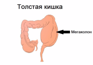 мегаколон кишечника