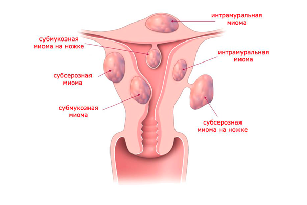 Укорачивание менструального цикла из-за миомы матки