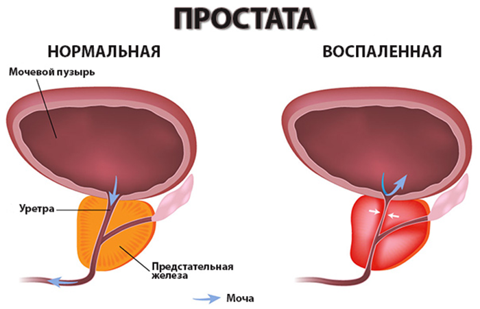 Простата в нормальном состояние и воспаленном