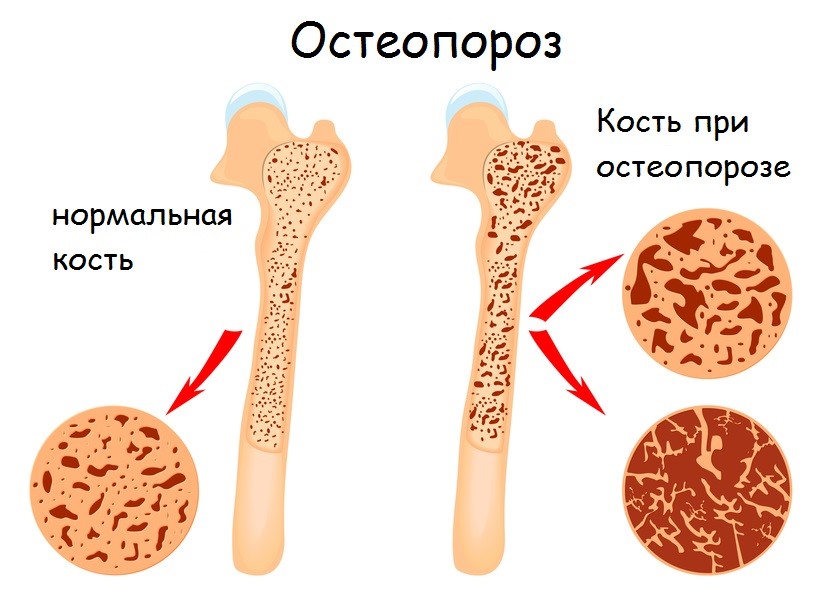 профилактика остеопороза при климаксе