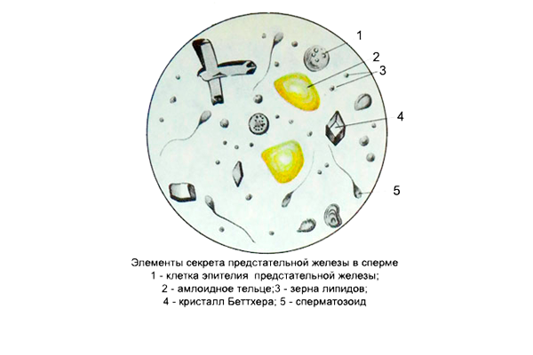 Липоидные тельца в сперме