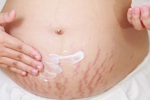 фиолетовые растяжки на животе во время беременности