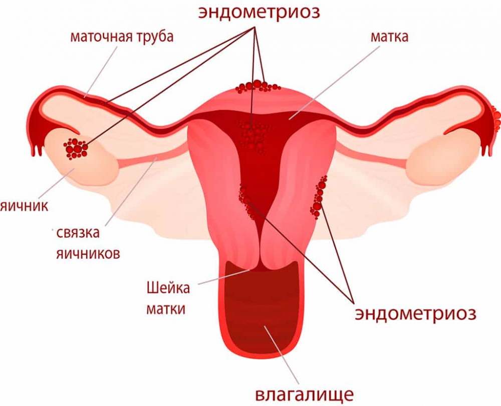 Эндометриоз матки при климаксе: симптомы и лечение, прогноз
