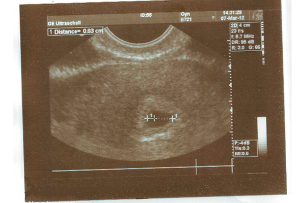 Первое УЗИ беременной