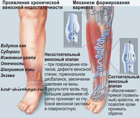 Варикоз на ногах лечение, профилактика и причина варикоза,закупорка вен