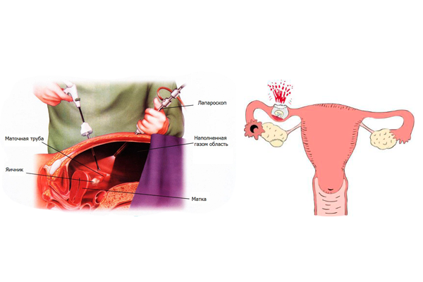Лечение внематочной беременности методом лапароскопии
