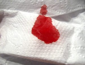 кровотечение из прямой кишки