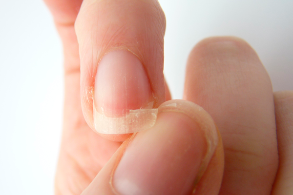 Ломкость ногтей из-за нехватки витамина Д