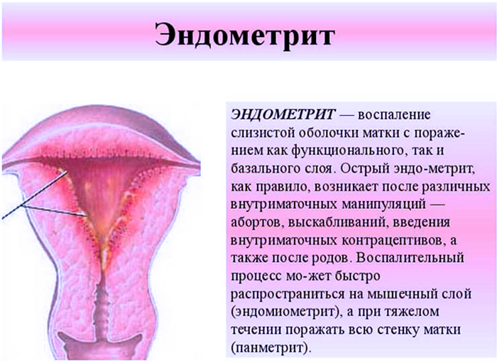Классификация Эндометрита 