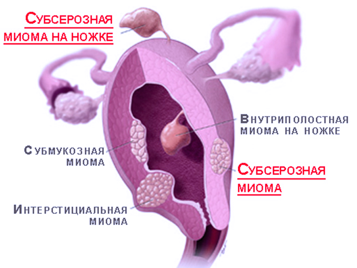 Виды миомы матки при провидении лапороскопической операции